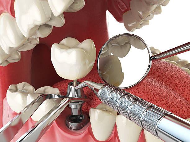Best Emergency Dental Care for Broken or Chipped Teeth in Germantown, IL
